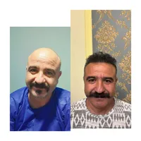 کاشت مو  ابرو  ریش به روش شیرازی|خدمات آرایشگری و زیبایی|سنندج, |دیوار