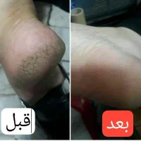 درمان خشکی و ترک پا