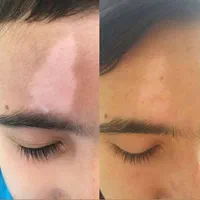 درمان تضمینی پیسی و پسوریازیس