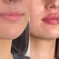 نیازمند مدل تزریق زیرچشم ژل لب بوتاکس مزوژل رایگان