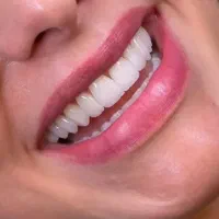 عصب کشی و پر کردن ، کشیدن و جراحی دندان ، ایمپلنت