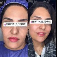 ساکشن غبغب وتزریق چربی بصورت و هرناحیه ازبدن درمطب|خدمات آرایشگری و زیبایی|قم, زنبیل آباد|دیوار