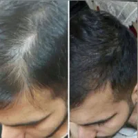 پک تخصصی درمان ریزش مو و رویش مجدد مو