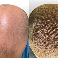 کاشت حرفه ای ابرو و مو در مجهزترین مرکز  کاشت