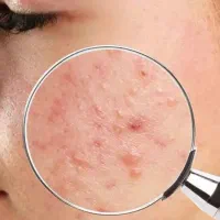 رفع جوش صورت و اسکار پوستی