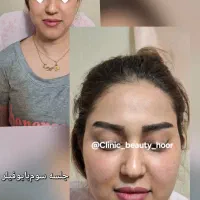 تزریق ژل طبیعی فیلر بوتاکس(کلینیک زیبایی گلد)|خدمات آرایشگری و زیبایی|سنندج, |دیوار