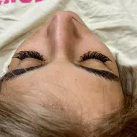 کاشت هیدن مژه