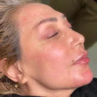 تزریق ژل و بوتاکس|خدمات آرایشگری و زیبایی|ارومیه, |دیوار