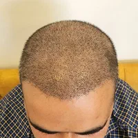 کاشت مو تخصصی