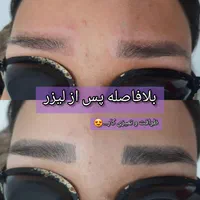 لیزر پاکسازی تتو روشن سازی تخصصی صورت و نواحی تیره