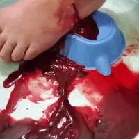 درمان کمردردوسیاتیک کتف