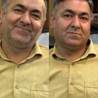 پروتز موی طبیعی زنانه مردانه