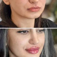 خدمات ویژه، فیلر ژل، بوتاکس، پی ار پی، فیشال