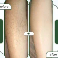 آموزش نخ لیفت فیلر ژل بوتاکس لیزر مو فشیال طب سنتی|خدمات آموزشی|اصفهان, مرداویج|دیوار