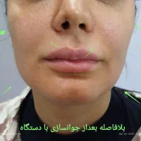 جوانسازی قوی بدون مواد