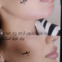 تزریق فیلر به روش mdcodes|خدمات آرایشگری و زیبایی|اسلام‌شهر, شهرک واوان|دیوار