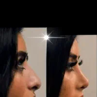 جراحی بینی  (پیکر تراشی تخصصی) لیپوابدو.مامو.لیفت