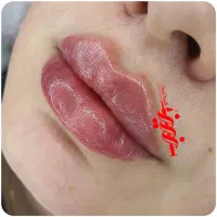 تزریق فیلر ژل و بوتاکس در کلینیک|خدمات آرایشگری و زیبایی|بندرعباس, |دیوار