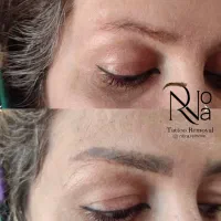 پاک کردن تتو با لیزر/ریموو ابرو/کربن تراپی(پزشک)|خدمات آرایشگری و زیبایی|مشهد, فردوسی|دیوار