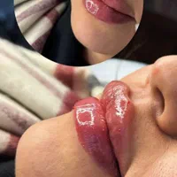 پاکسازی پوست ، ژل و بوتاکس