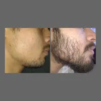 ریشو شو|آرایشی، بهداشتی، درمانی|کوار, |دیوار