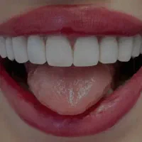 کامپوزیت دندان. ونیر کامپوزیت