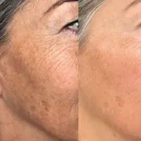 بوتاکس فوری ، ۵ کاره ، ضد چروک ، روشن کننده/ اصل