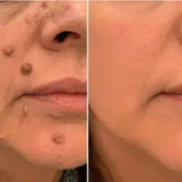 جشنواره تخفیف ویژه حذف خال،لک،ککومک پوستی،تتو ابرو