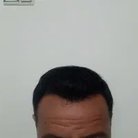 کاشت مو 12 میلیون