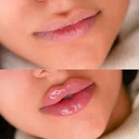 مدل ژل و بوتاکس یلدایی