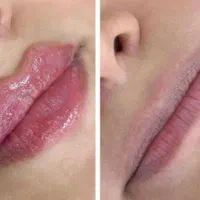 تزریق ژل  بوتاکس  فیلر  پرسینگ|خدمات آرایشگری و زیبایی|قم, نیروگاه|دیوار