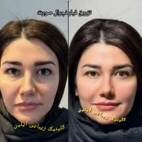 جشنواره لیزر مو/تتو/کربن فیلر بوتاکس پی آر پی مزو