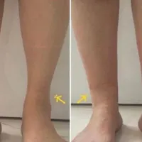 تزریق فیلرهای بدن(دست-مچ پا-باسن)ساکشن غبغپ|خدمات آرایشگری و زیبایی|اصفهان, ملک‌شهر|دیوار
