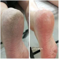 خدمات تخصصی پدیکور پا