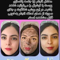 لیزرمو ریموتتوخالکوبی خالبرداری لیپوم مزوتراپی جوش|خدمات آرایشگری و زیبایی|نجفآباد, بازار|دیوار