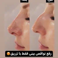 اصلاح فرم بینی باتزریق فیلربدون جراحی باقیمت عالی|خدمات آرایشگری و زیبایی|اصفهان, وحید|دیوار