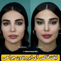 آف پکیج تخصصی FOX EYE پزشک پوست مو بینی زیبایی|خدمات آرایشگری و زیبایی|مشهد, هنرستان|دیوار