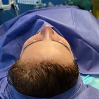 جراحی بینی با تخفیف ۴۰ میلیونی