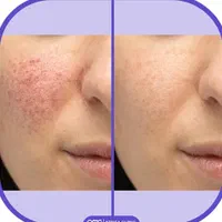 لیزر جای جوش و زخم.منافذ پوست