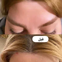 تزریق بوتاکس کل صورت و زیر بغل|خدمات آرایشگری و زیبایی|کرمانشاه, |دیوار