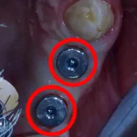 مرکزتخصصی ایمپلنت بدون دردو خونریزی/وام قرض الحسنه|خدمات آرایشگری و زیبایی|اصفهان, ملک|دیوار