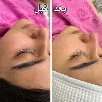 مدل فیشال تخصصی صورت می‌پذیرم (شرق تهران)