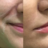 ژل لب فیلر بوتاکس پی ار پی فیلر گونه خط خنده|خدمات آرایشگری و زیبایی|کاشان, طالقانی|دیوار