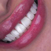 دندان پزشکی ایمپلنت روکش ارتودنسی اقساطی|خدمات آرایشگری و زیبایی|مراغه, |دیوار