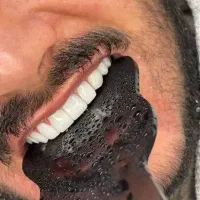 کامپوزیت دندان|خدمات آرایشگری و زیبایی|اردبیل, |دیوار