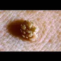 کلینیک درمان زگیل پوستی/کرایوتراپی و لیزر/HPV|خدمات زیبایی و سلامت|اهواز, کیانپارس |دیوار