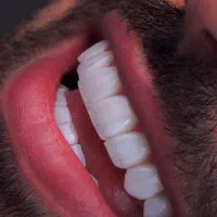 کامپوزیت لمینیت ایمپلنت نقد و اقساط