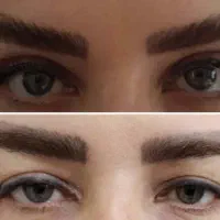 تزریق چربی به صورت وبلفاروپلاستی پلک قیمت عالی