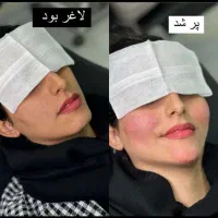 تخفیف جشنواره تزریق ژل و فیلر لب و فول فیس در مطب|خدمات آرایشگری و زیبایی|اصفهان, چرخاب|دیوار