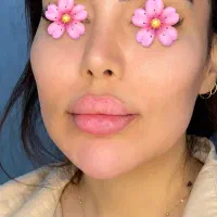 تخفیف ویژه یلدایی ژل بوتاکس در (کلینیک نیلا)